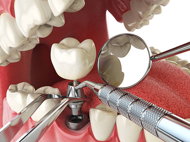 Best Emergency Root Canal Treatment in Mendon, UT